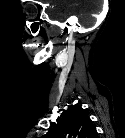 File:Carotid body tumor (Radiopaedia 39845-42300 D 13).jpg