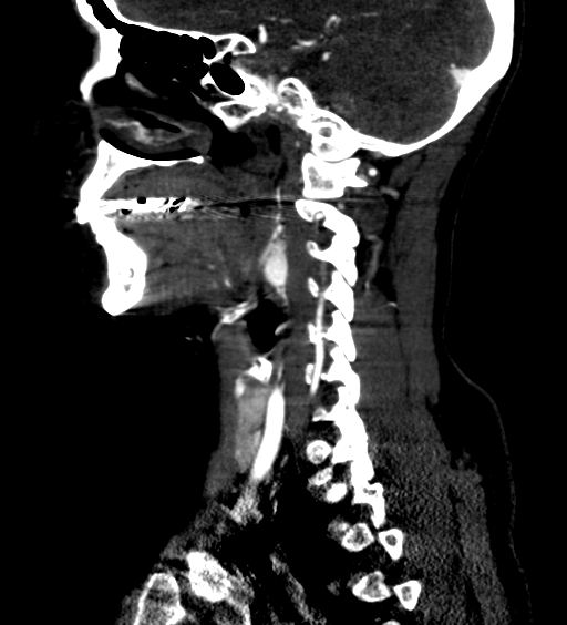 File:Carotid body tumor (Radiopaedia 39845-42300 D 58).jpg