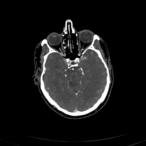 File:Carotid body tumor (Radiopaedia 83615-98727 A 5).jpg