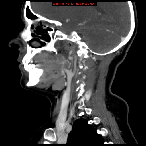 Carotid body tumor with lung metastases (Radiopaedia 9301-9986 Sagittal C+ delayed 18).jpg
