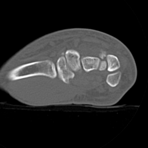 File:Carpo-metacarpal fracture-dislocations with hamatum split fracture (Radiopaedia 18482-18343 Axial bone window 21).jpg