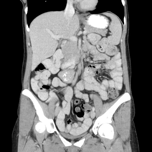 Castleman disease with fibrous pseudotumor in the abdomen (Radiopaedia 77296-89373 B 42).jpg