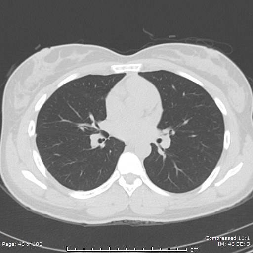 Catamenial pneumothorax (Radiopaedia 54382-60600 Axial non-contrast 46).jpg