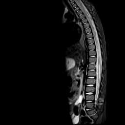 File:Caudal regression syndrome (Radiopaedia 61990-70072 Sagittal T2 TIRM 4).jpg