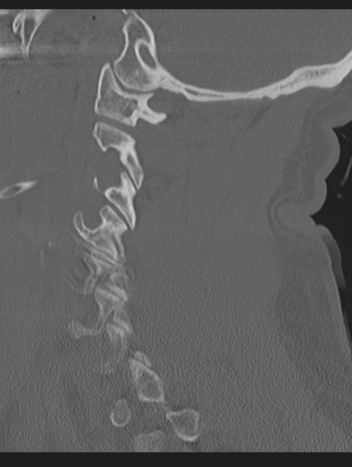 Cavernoma of cervical cord (Radiopaedia 50838-56346 Sagittal bone window 27).png