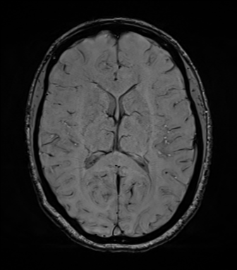 File:Cavernoma with bleed - midbrain (Radiopaedia 54546-60773 Axial SWI 27).png