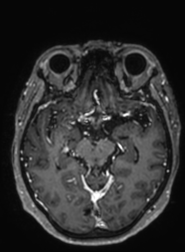 Cavernous hemangioma of the cerebellar falx (Radiopaedia 73025-83724 Axial T1 C+ 199).jpg