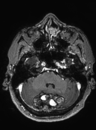 Cavernous hemangioma of the cerebellar falx (Radiopaedia 73025-83724 Axial T1 C+ 254).jpg