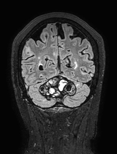 Cavernous hemangioma of the cerebellar falx (Radiopaedia 73025-83724 Coronal FLAIR 280).jpg