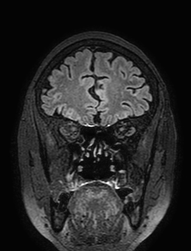 Cavernous hemangioma of the cerebellar falx (Radiopaedia 73025-83724 Coronal FLAIR 79).jpg