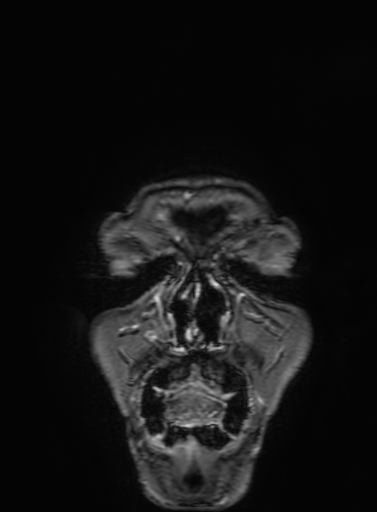 Cavernous hemangioma of the cerebellar falx (Radiopaedia 73025-83724 Coronal T1 C+ 5).jpg