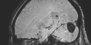 Cavernous hemangioma of the cerebellar falx (Radiopaedia 73025-83724 Sagittal BOLD 136).jpg