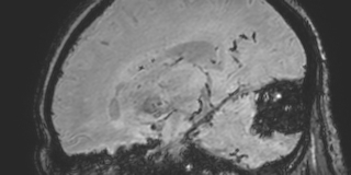 Cavernous hemangioma of the cerebellar falx (Radiopaedia 73025-83724 Sagittal BOLD 76).jpg