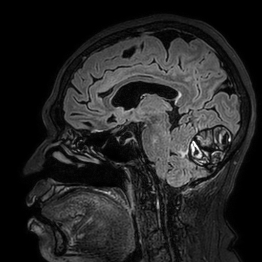 Cavernous hemangioma of the cerebellar falx (Radiopaedia 73025-83724 Sagittal FLAIR 118).jpg