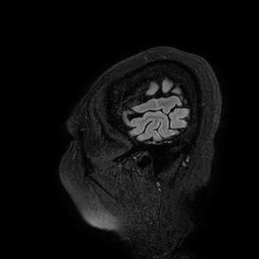 Cavernous hemangioma of the cerebellar falx (Radiopaedia 73025-83724 Sagittal FLAIR 5).jpg