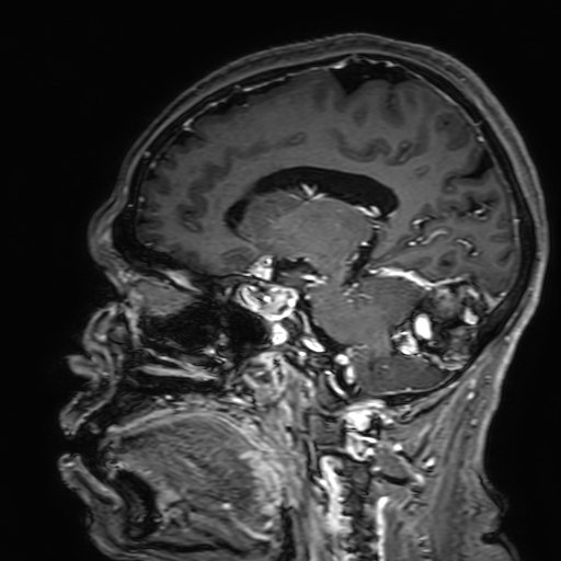 File:Cavernous hemangioma of the cerebellar falx (Radiopaedia 73025-83724 Sagittal T1 C+ 126).jpg