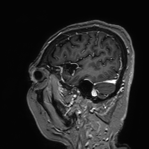 File:Cavernous hemangioma of the cerebellar falx (Radiopaedia 73025-83724 Sagittal T1 C+ 38).jpg
