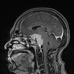 Cavernous sinus meningioma (Radiopaedia 63682-72367 Sagittal T1 C+ 89).jpg
