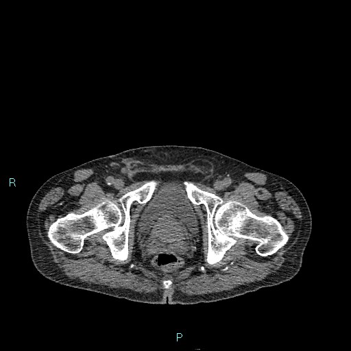Cecal bascule (Radiopaedia 85770-101586 Axial non-contrast 104).jpg