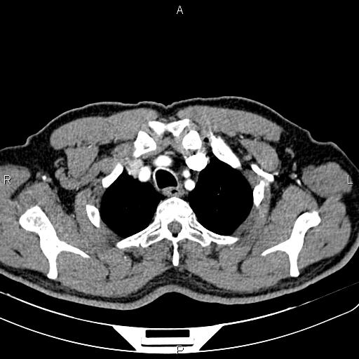 File:Cecal cancer with appendiceal mucocele (Radiopaedia 91080-108651 A 13).jpg