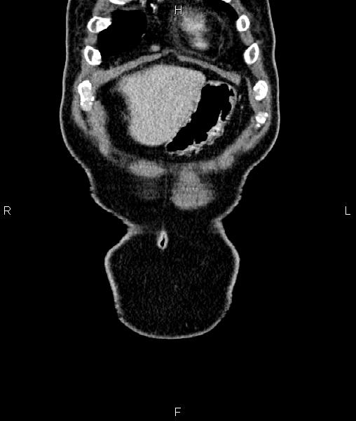 Cecal cancer with appendiceal mucocele (Radiopaedia 91080-108651 D 5).jpg