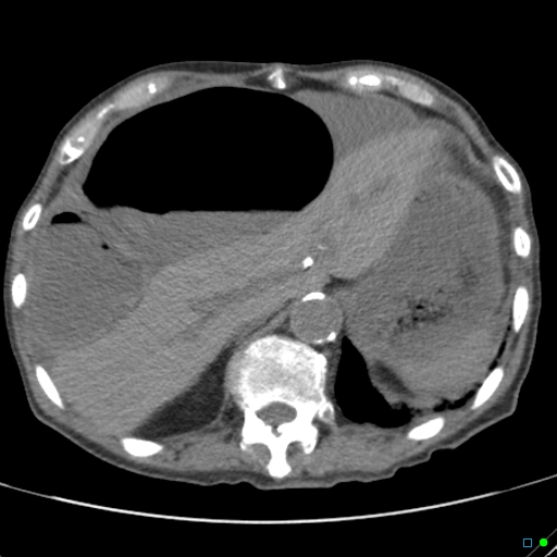 Cecal volvulus - atypical (Radiopaedia 21637-21588 non-contrast 15).jpg