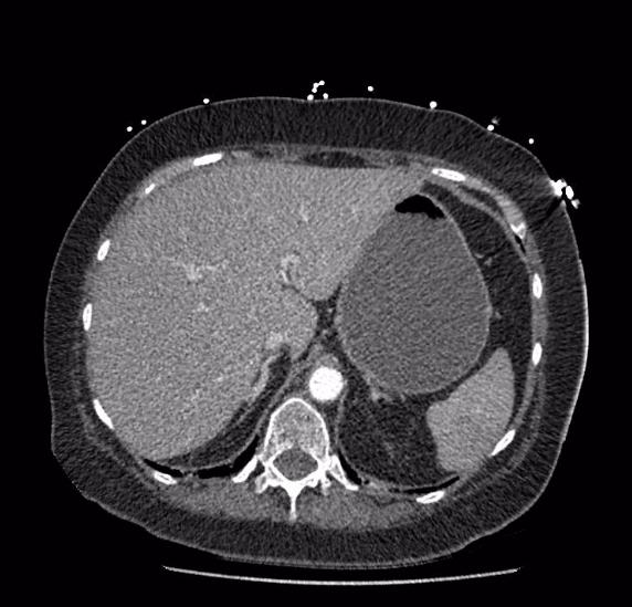 Celiac artery severe stenosis and dissection (Radiopaedia 44128-47842 B 16).jpg