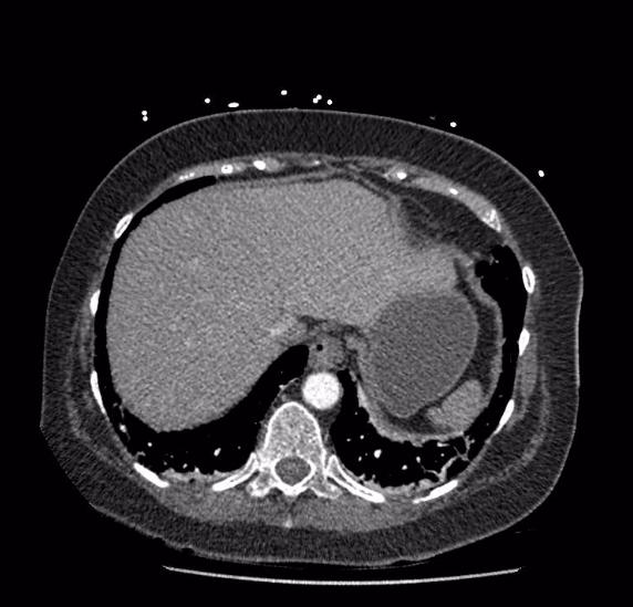 Celiac artery severe stenosis and dissection (Radiopaedia 44128-47842 B 6).jpg