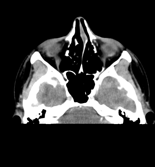 Cemento-ossifying fibroma (Radiopaedia 46243-50643 Axial C+ delayed 19).png