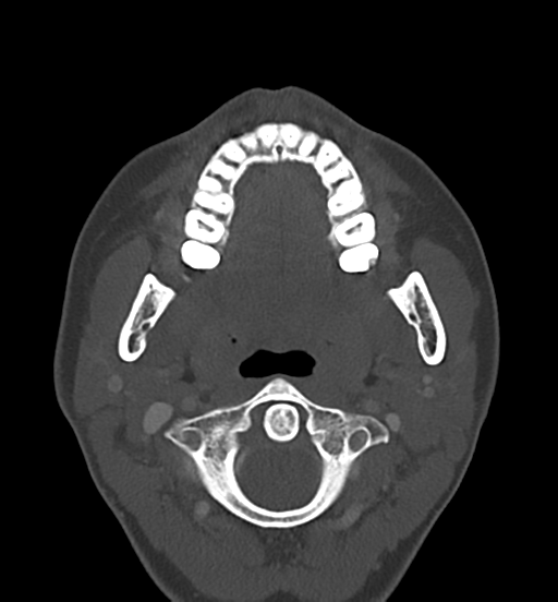 Cemento-ossifying fibroma (Radiopaedia 46243-50643 Axial bone window 35).png