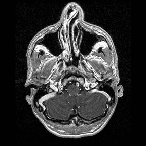 Central-variant posterior reversible encephalopathy syndrome (PRES) (Radiopaedia 43880-47358 Axial T1 C+ 14).jpg