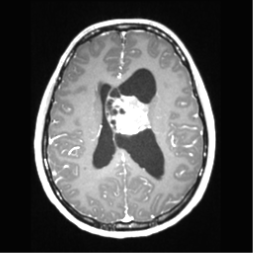 Central neurocytoma (Radiopaedia 37664-39557 Axial T1 C+ 49).png