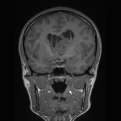 Central neurocytoma (Radiopaedia 37664-39557 Coronal T1 53).png