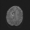Central neurocytoma (Radiopaedia 56690-63469 Axial DWI 34).jpg