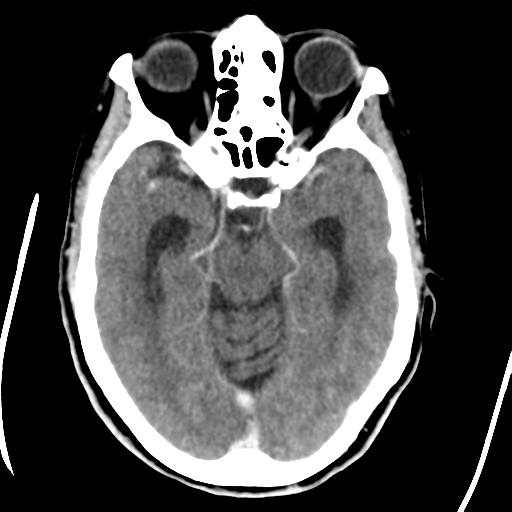 Central neurocytoma (Radiopaedia 65317-74346 Axial C+ delayed 19).png