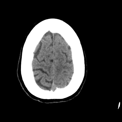 Central neurocytoma (Radiopaedia 65317-74346 Axial non-contrast 43).png