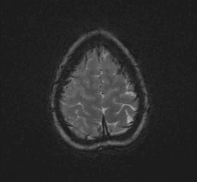 Central neurocytoma (Radiopaedia 70263-80336 Axial SWI 54).jpg