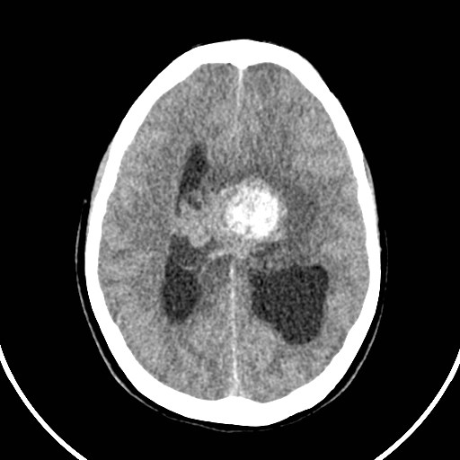 Central neurocytoma (Radiopaedia 84497-99871 Axial non-contrast 32).jpg