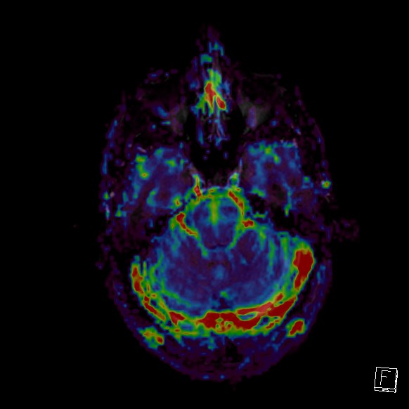 Central neurocytoma (Radiopaedia 84497-99872 Axial Perfusion 237).jpg