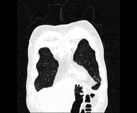 Centrilobular pulmonary emphysema (Radiopaedia 62468-70718 Coronal lung window 10).jpg