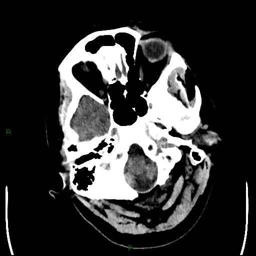 Cerebellar abscess (Radiopaedia 78135-90671 Axial non-contrast 17).jpg