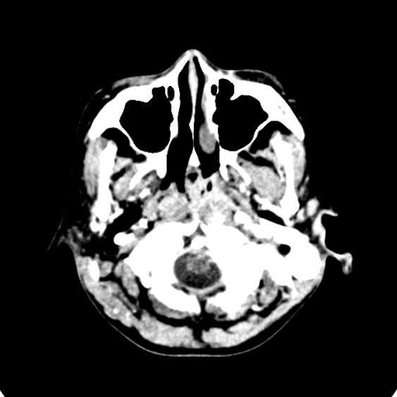 Cerebellar abscess secondary to mastoiditis (Radiopaedia 26284-26412 Axial C+ delayed 9).jpg