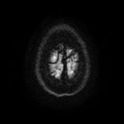 Cerebellar hemangioblastoma (Radiopaedia 29570-30077 Axial DWI 25).jpg