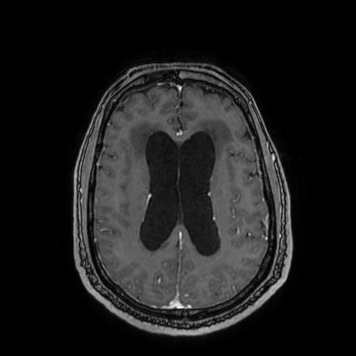 Cerebellar hemangioblastoma (Radiopaedia 88055-104622 Axial T1 C+ 113).jpg