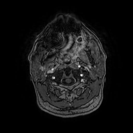 Cerebellar hemangioblastoma (Radiopaedia 88055-104622 Axial T1 C+ 14).jpg