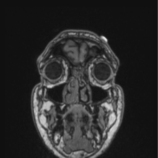 File:Cerebellar hemangioblastomas and pituitary adenoma (Radiopaedia 85490-101176 Coronal T1 82).png
