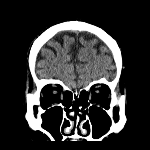 Cerebellar hemorrhage (Radiopaedia 27193-27359 Coronal non-contrast 14).jpg