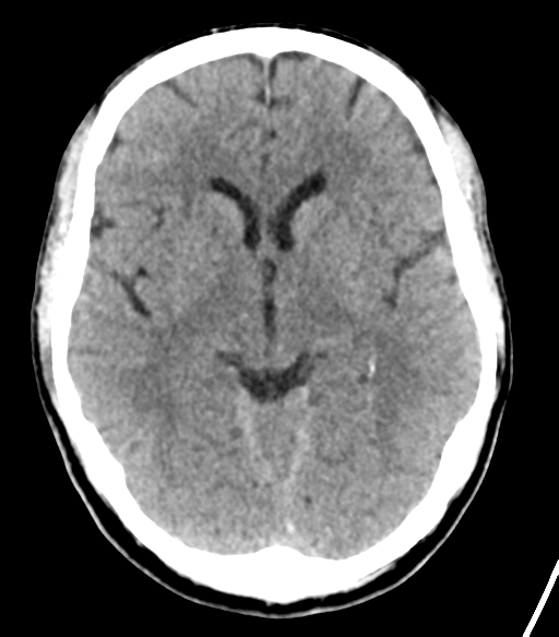 File:Cerebellar hemorrhage (Radiopaedia 37000-38669 Axial non-contrast 19).png