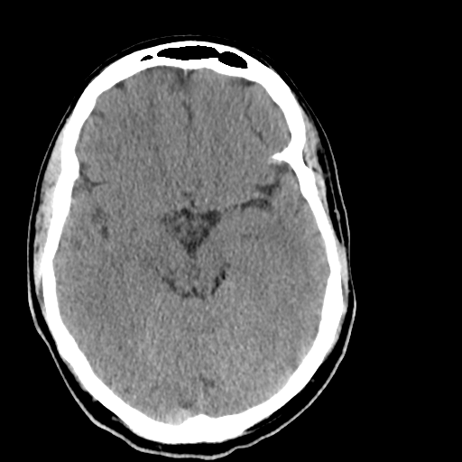 File:Cerebellar infarct due to vertebral artery dissection with posterior fossa decompression (Radiopaedia 82779-97029 Axial non-contrast 10).png