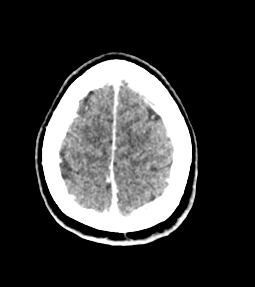 Cerebellar metastases - colorectal adenocarcinoma (Radiopaedia 40947-43652 Axial C+ 56).png